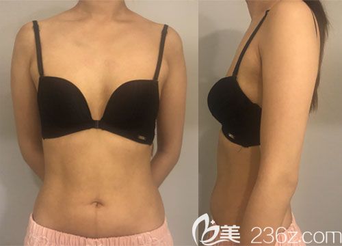 韩国普罗菲耳魔笛假体隆胸案例