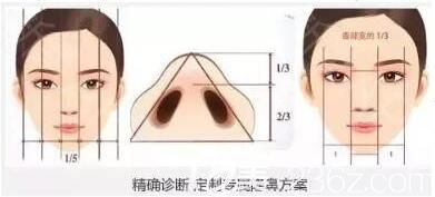 肋软骨隆鼻 肋软骨隆鼻