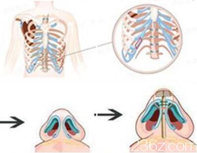 肋软骨隆鼻效果怎么样? 肋软骨隆鼻效果怎么样?