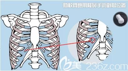 肋软骨隆鼻术后效果自然吗? 肋软骨隆鼻术后效果自然吗?