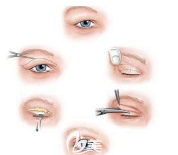全切双眼皮手术示意图