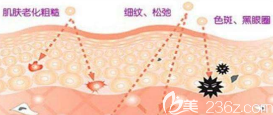 光子嫩肤治疗示意图