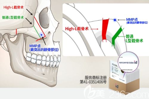 韩国id的High-L颧骨颧弓截骨术