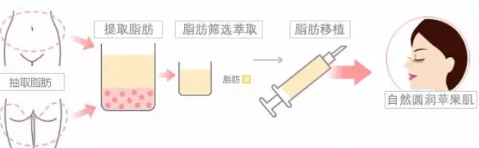 自体脂肪填充苹果肌手术过程图