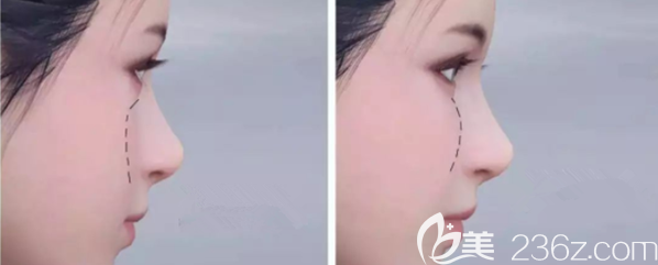 自体脂肪填充苹果肌效果图