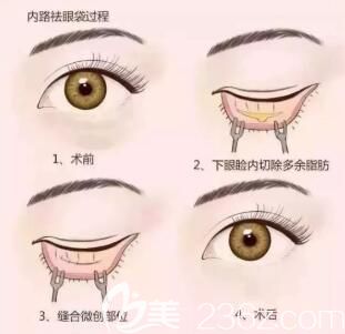 内切去眼袋