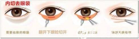 内切去眼袋术后效果怎么样？
