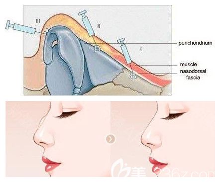 注射玻尿酸改善轻微驼峰鼻