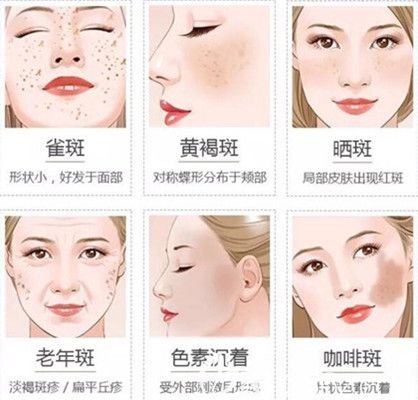 常见脸部皮肤色斑问题
