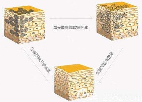 超皮秒解决面部色素原理