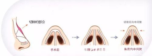 中度驼峰鼻需要切除鼻部凸起的软骨