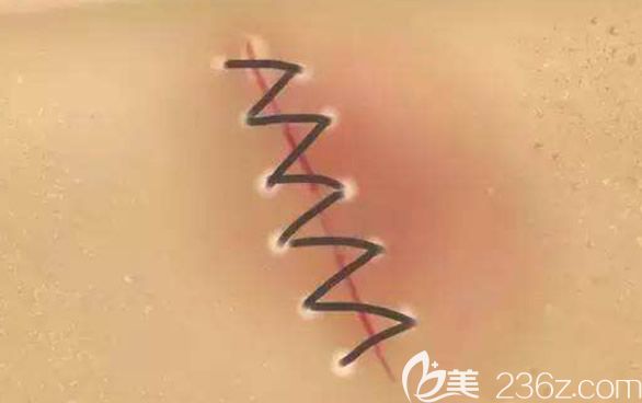 缝针的疤痕能去掉吗