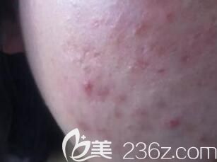 光子嫩肤和微针哪个祛痘印痘坑效果好？