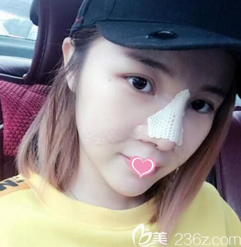 韩国清潭first整形外科医院鼻修复术后3天恢复照片