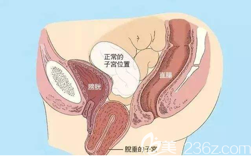 脱垂子宫与正常子宫示意图