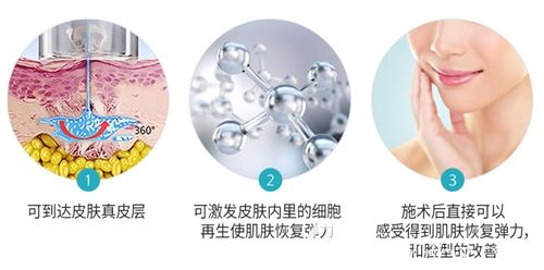 韩国ID面部气波提升效果 韩国ID面部气波提升效果