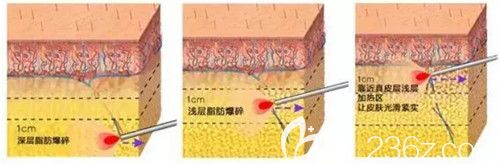 激光溶脂瘦脸手术过程