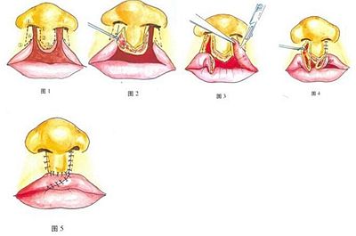 双侧唇裂矫正的手术方法原理