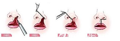 单侧兔唇的手术方法原理
