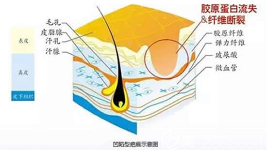 凹陷性疤痕示意图 凹陷性疤痕示意图