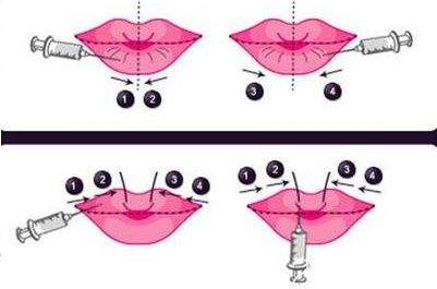 玻尿酸丰唇学名就是透明质酸丰唇