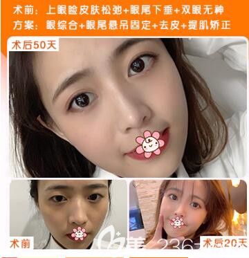 贵阳美贝尔上眼睑提肌 贵阳美贝尔上眼睑提肌