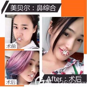 贵阳美贝尔隆鼻怎么样 贵阳美贝尔隆鼻怎么样