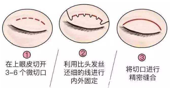 上海愉悦美联臣医疗美容医院陈红梅切开双眼皮 上海愉悦美联臣医疗美容医院陈红梅切开双眼皮