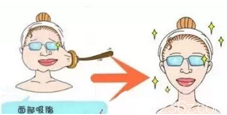 上海愉悦美联臣医疗美容医院裴仁镐面部吸脂 上海愉悦美联臣医疗美容医院裴仁镐面部吸脂