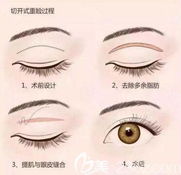 全切双眼皮手术过程示意图