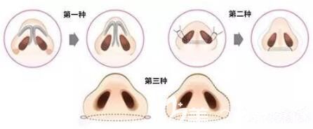 鼻头缩小的三种方式