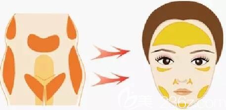 自体脂肪移植填充面部位置