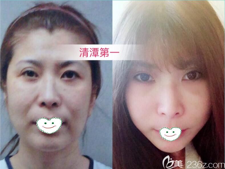 线雕提升和拉皮手术哪个更长久 韩国清潭first整形医院邀您体验 纵深肌理归位术 整形行业新闻话题 美佳网