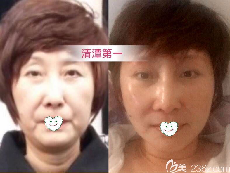 在韩国清潭first做小切口面部提升术前后效果对比图