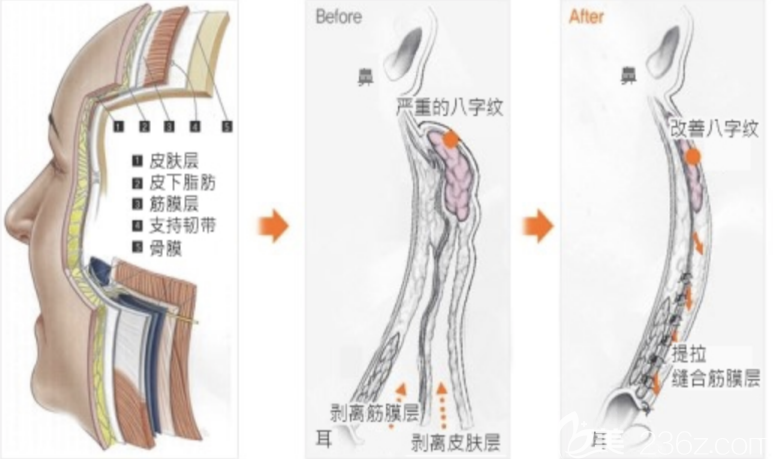 纵深肌理归位术提升效果模拟图
