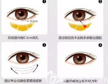 泪沟填充手术示意图