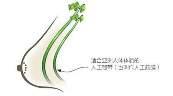 不开刀人工韧带乳房提升术优势介绍