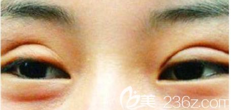 埋线双眼皮不对称 埋线双眼皮不对称
