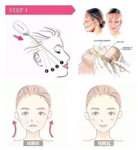 尹延喜医生做面部线雕提升手术过程 尹延喜医生做面部线雕提升手术过程