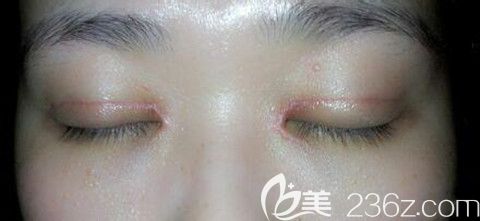 双眼皮术后护理不当造成双眼皮疤痕增生