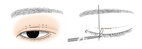 东方艺整形双眼皮疤痕修复