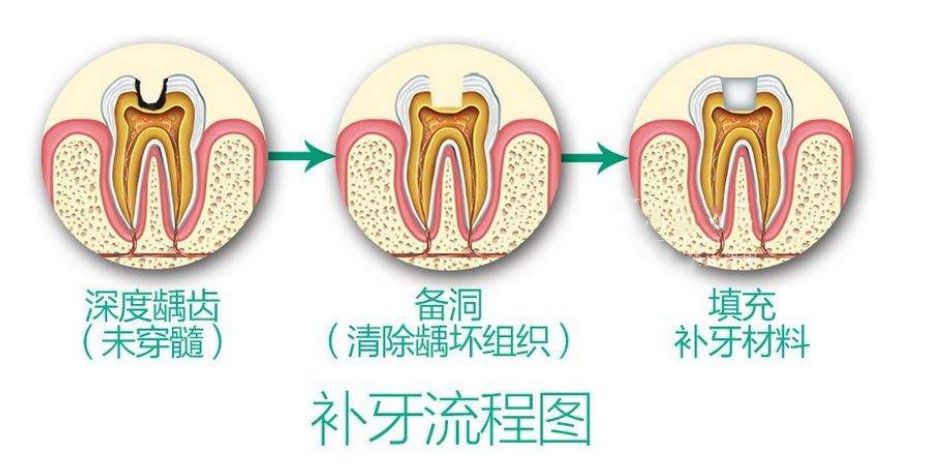 佳美口腔补牙流程图 佳美口腔补牙流程图