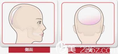 后脑勺骨水泥填充手术后正面、侧面效果图 后脑勺骨水泥填充手术后正面、侧面效果图