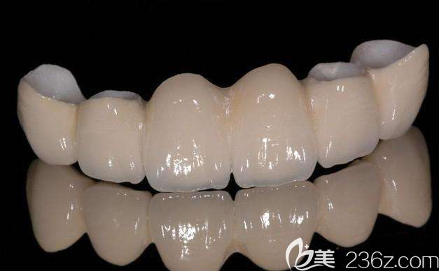 烤瓷牙图示 烤瓷牙图示