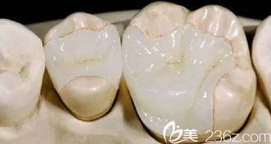 牙齿做完嵌体之后的图片 牙齿做完嵌体之后的图片