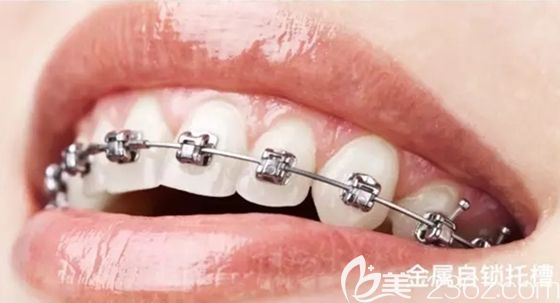 想在杭州做牙齿整形?不妨来维乐口腔了解下,而且金属托槽牙齿矫正价格才9800元起