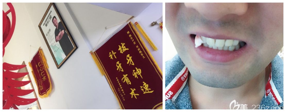 洛阳维乐口腔邓医生拔智齿后评价 洛阳维乐口腔邓医生拔智齿后评价