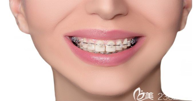 陶瓷托槽半隐形矫正图 陶瓷托槽半隐形矫正图