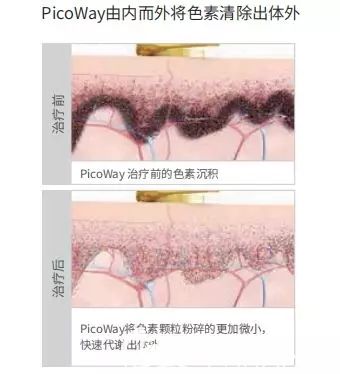 相比于传统激光,皮秒激光不容易复发和反黑 相比于传统激光,皮秒激光不容易复发和反黑