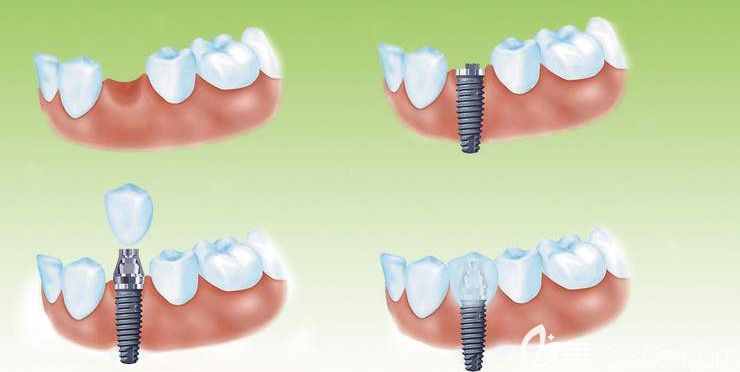 种植牙操作过程 种植牙操作过程